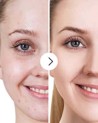 Cápsulas para eliminar el acné, los granos e imperfecciones con zinc, vitamina C, E y B2 Derminax_5 - 5