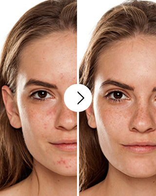 Cápsulas para eliminar el acné, los granos e imperfecciones con zinc, vitamina C, E y B2 Derminax_2 - 2