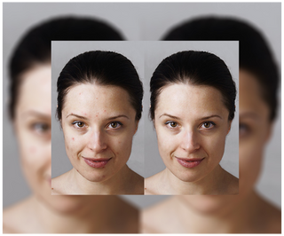 Cápsulas para eliminar el acné, los granos e imperfecciones con zinc, vitamina C, E y B2 Derminax