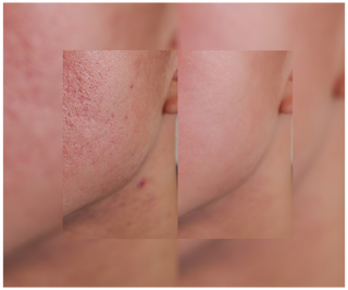 Cápsulas para eliminar el acné, los granos e imperfecciones con zinc, vitamina C, E y B2 Derminax