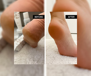 Sales de baño para pies con urea 45% Refeet