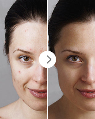 Cápsulas para eliminar el acné, los granos e imperfecciones con zinc, vitamina C, E y B2 Derminax