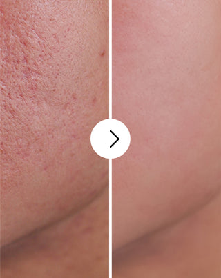 Cápsulas para eliminar el acné, los granos e imperfecciones con zinc, vitamina C, E y B2 Derminax - 6