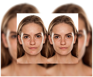 Cápsulas para eliminar el acné, los granos e imperfecciones con zinc, vitamina C, E y B2 Derminax