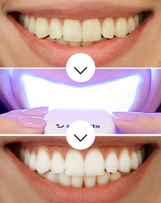 Kit de blanqueamiento dental con lámpara LED y gel blanqueador Light &amp; Bright Smilebite